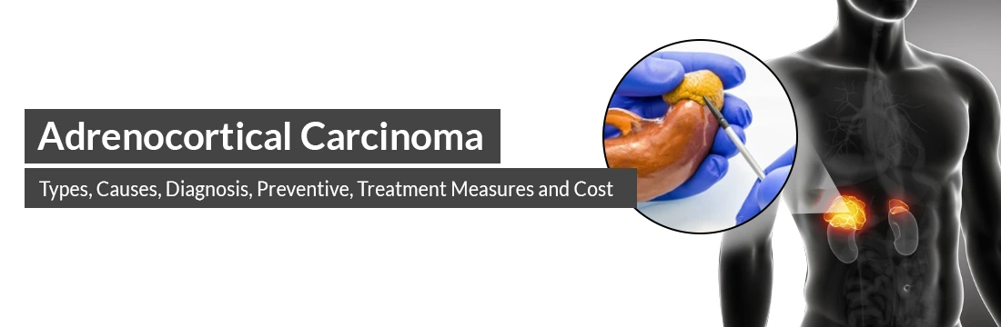 Adrenocortical Carcinoma: Types, Causes, Diagnosis, Preventive, Treatment Measures, and Cost